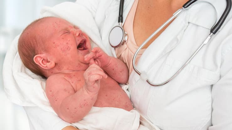 תינוק חולה חצבת