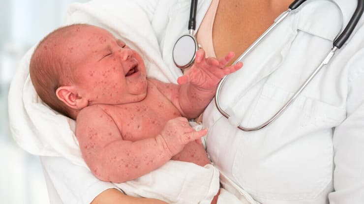 תינוק חולה חצבת