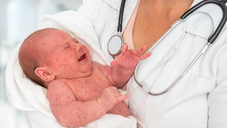 תינוק חולה חצבת