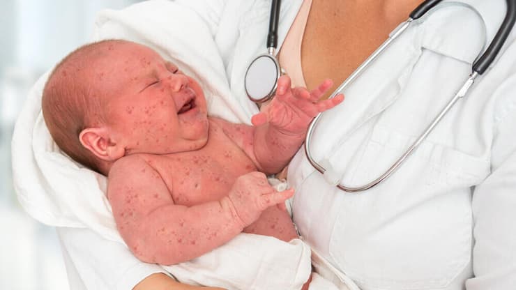 תינוק חולה חצבת