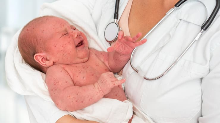 תינוק חולה חצבת