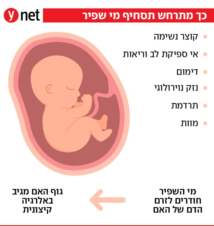 אינפו תסחיף מי שפיר
