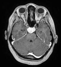 הגידול שפגע בראייה של עדי חנוכייב