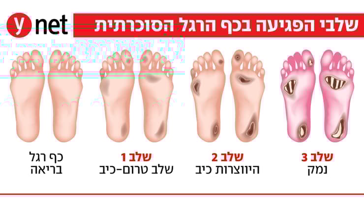 אינפו כף רגל סוכרתית