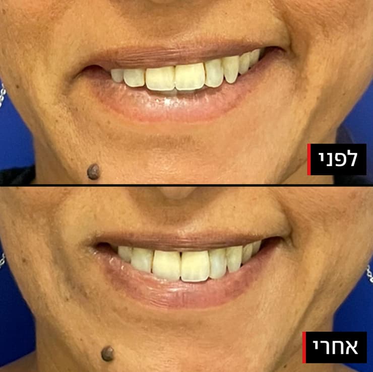 לפני ואחרי כריתת שריר בפנים בעקבות פציאליס