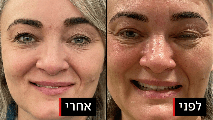 לפני ואחרי טיפול בבוטוקס בעקבות פציאליס