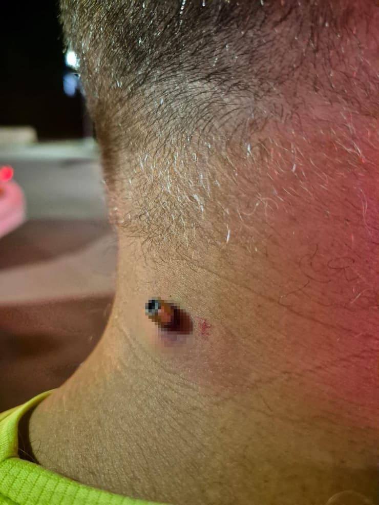 הקליע פגע בעורף, הולך הרגל נפצע קל (צילום: לפי סעיף 27א' לזכויות יוצרים מהרשתות החברתיות ) כדור תועה שפגע בצווארו של עובר אורח בפארק אגם מונפרט