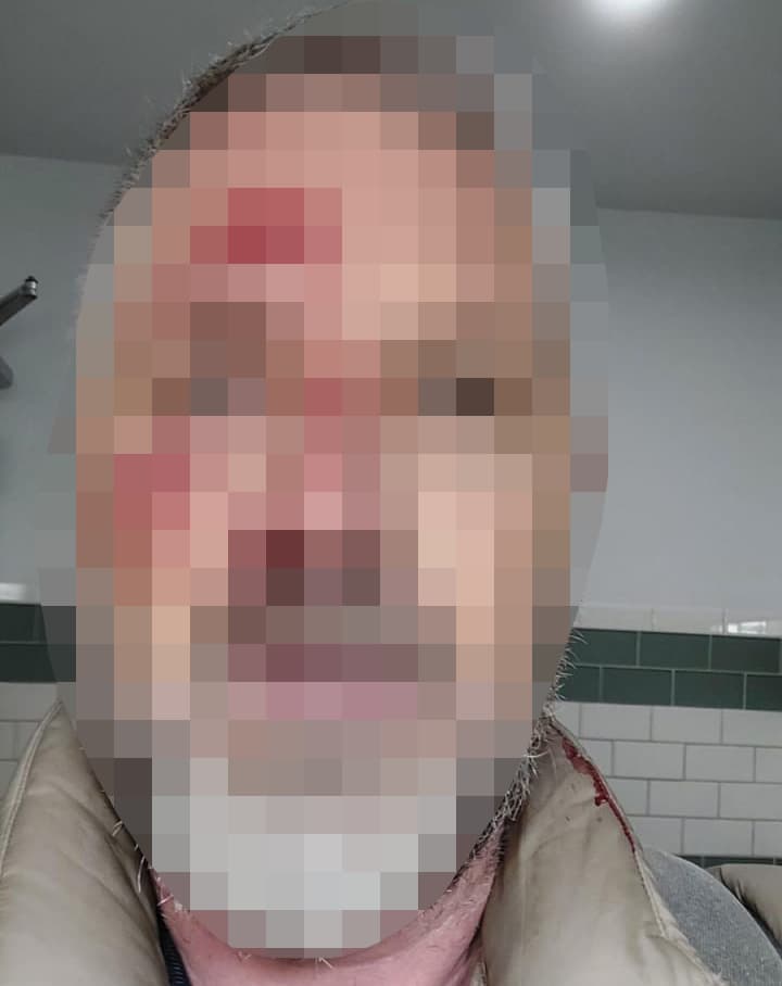 רמי גליקשטיין אחרי התקיפה. תמונת הפגיעה טושטשה לבקשתו (צילום: באדיבות המצולם ) רמי גליקשטיין, הותקף על רקע אנטישמי במנהטן