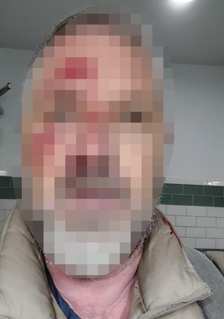 רמי גליקשטיין שהותקף במנהטן. תמונת הפציעה טושטשה לבקשתו (צילום: באדיבות המצולם) רמי גליקשטיין, הותקף על רקע אנטישמי במנהטן