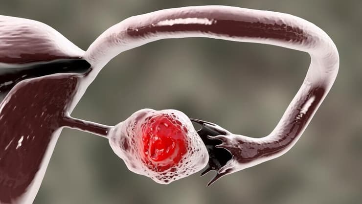 סרטן השחלות - גורם התמותה המוביל באונקולוגיה גינקולוגית. בתמונה: הדמיית תלת-ממד של סרטן השחלה (צילום: shutterstock) סרטן השחלות