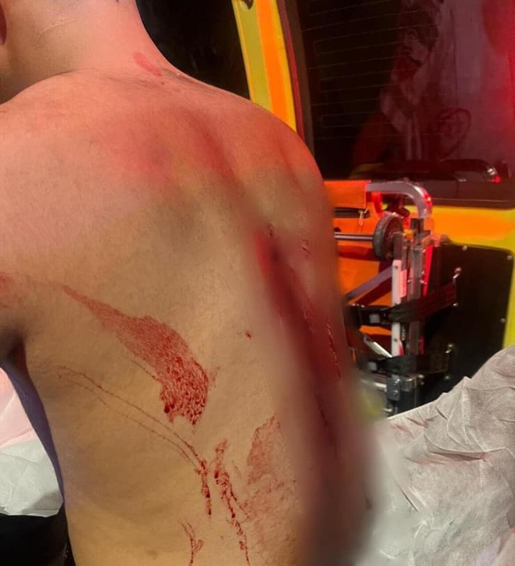 הפציעה של השליח (צילום: דוברות המשטרה) הפציעה של הקורבן