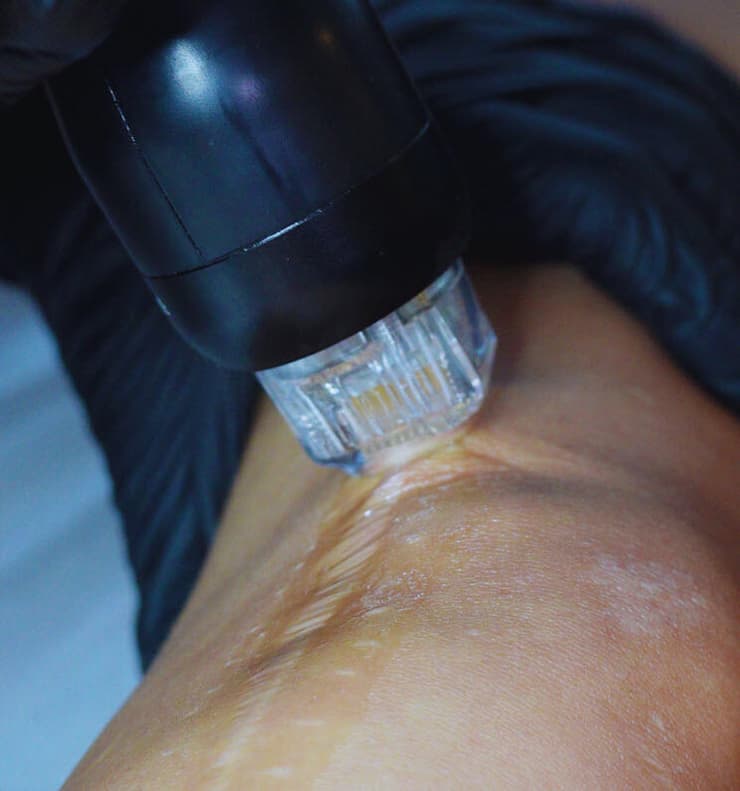 טיפול אסתטי בצלקת