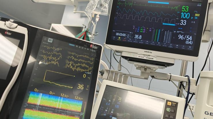 מעקב אחר הפעילות המוחית במטופלת תחת טשטוש, ללא סימני כאב בזמן ניתוח ללא הרדמה כללית