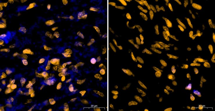 רקמת גידול סרטני מסוג גליובלסטומה שהוצאה מחולה ומיד הושרתה בתמיסה המכילה חומצה אמינית שרק חיידקים צורכים