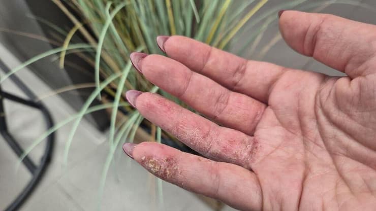 האוויר מתייבש ואיתו גם העור - אז איך שומרים עליו? עור יבש