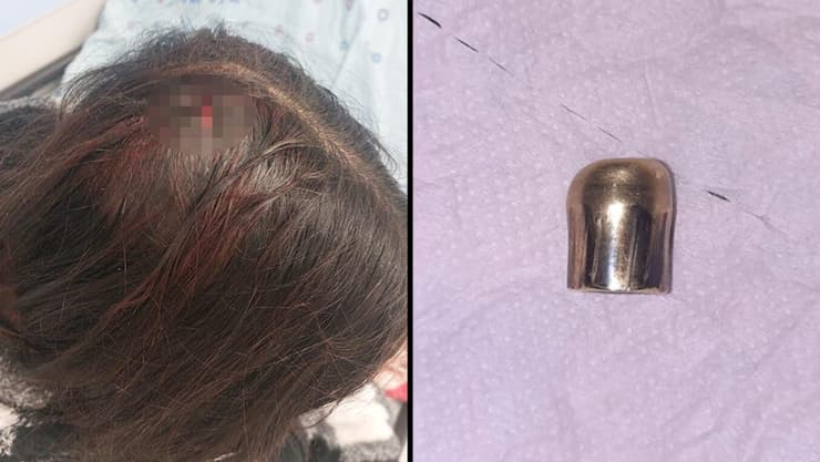 אורטל אלקיים נפגעה מכדור תועה במרפסת ביתה שבשכונת פסגת זאב בירושלים