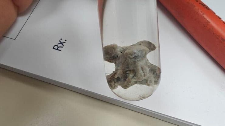 עצם ממרק עוף גרמה לדלקת ריאות חריפה (צילום: דוברות שערי צדק) עצם ממרק עוף גרמה לדלקת ריאות חריפה