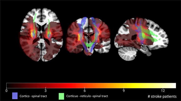 שבץ מוחי (צבעים אדום-צהוב) ומסלולים קורטיקליים (כחול וירוק) (צילום: באדיבות פיראס מואסי) שבץ מוחי (צבעים אדום-צהוב) ומסלולים קורטיקליים (כחול וירוק)