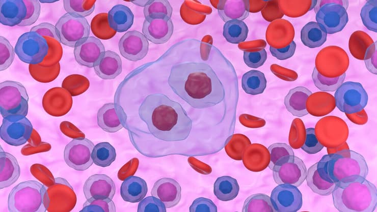 לימפומה מסוג הודג'קין