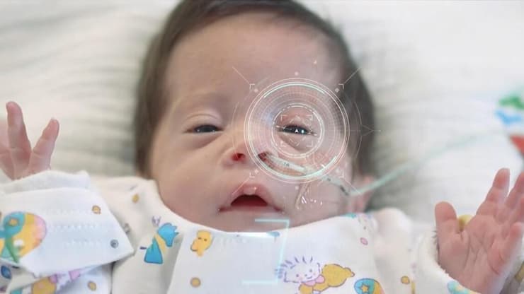 באמצעות צילום העיניים והעור שסביבן, ניתן להעריך בצורה מדויקת את רמת הבילירובין בדם (צילום: דוברות שניידר) ניטור לא פולשני צהבת ילדים, מרכז שניידר