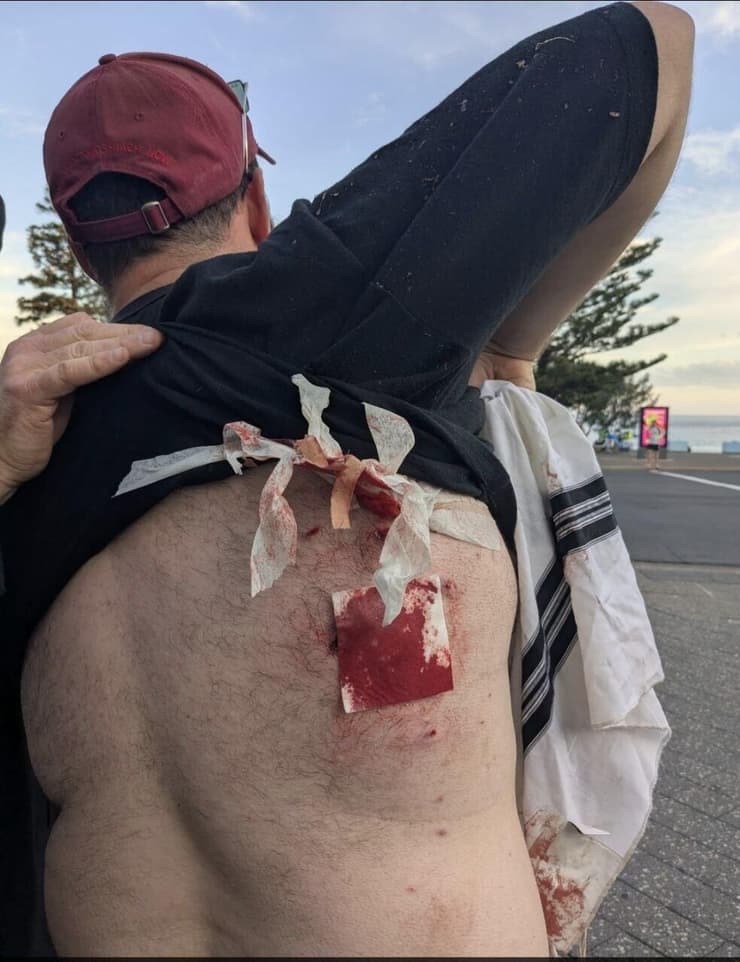 אחד הפצועים בזירה בבונדיי ביץ' (צילום: לפי סעיף 27א' לזכויות יוצרים ) תיעוד: ירי המוני במסיבת חנוכה בסידני שבאוסטרליה