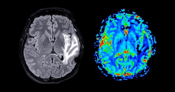 הדמיה של סריקרת מוח 