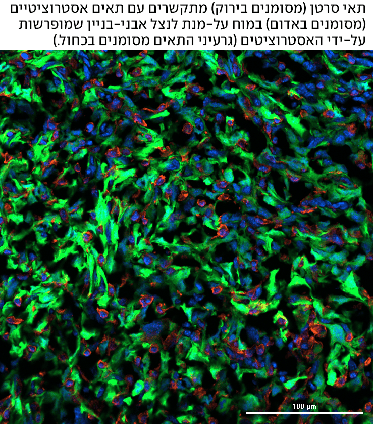 מחקר גרורות מוחיות בסרטן השד אוניברסיטת תל אביב