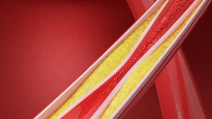 הצטברויות סידן בדפנות עורקים בתוך השד קשורות לסיכון מוגבר למחלות לב (צילום: Shutterstock) הצטברות סידן בדם