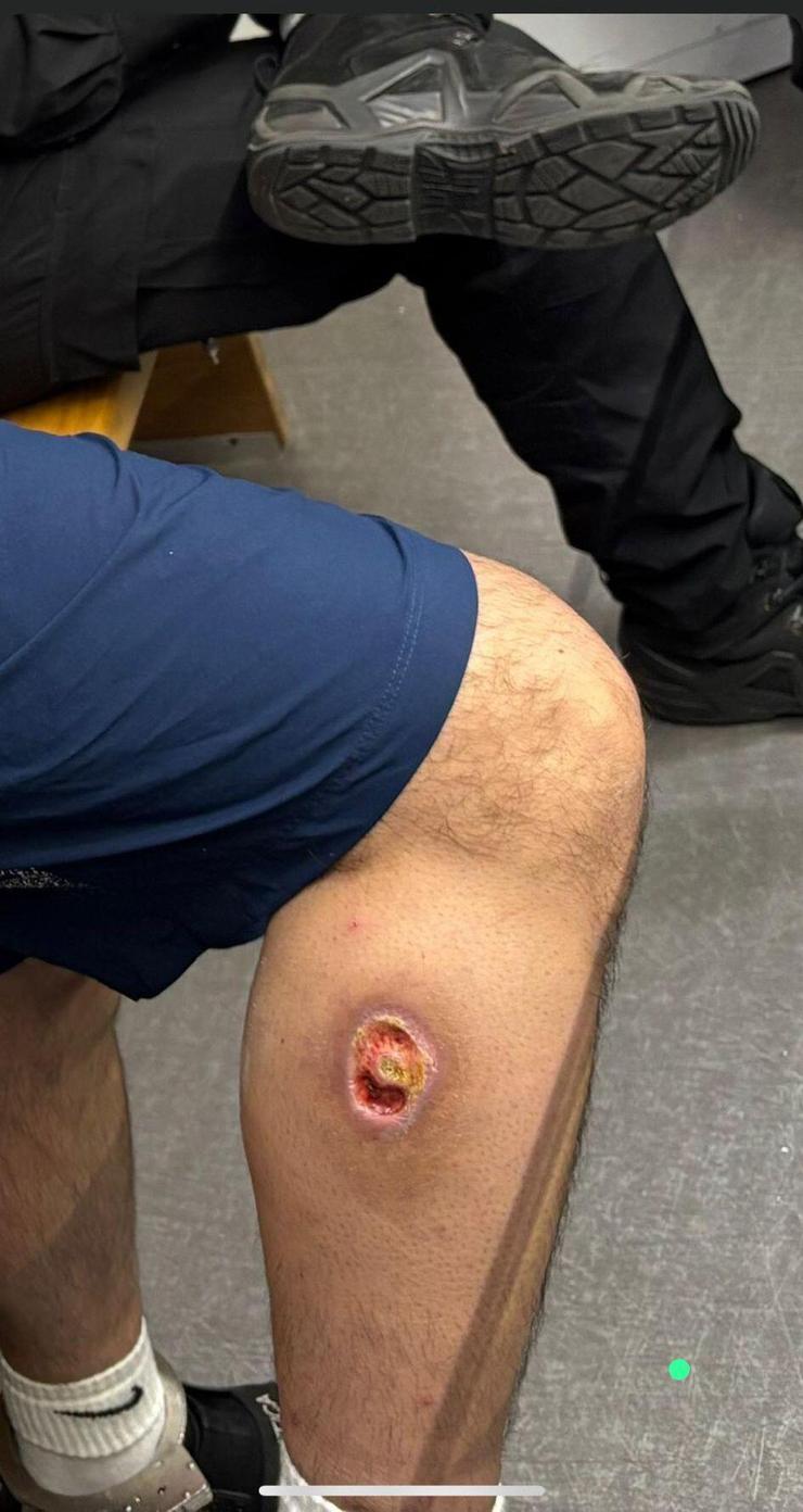 פגיעת כדור גומי ברגלו של אסיר