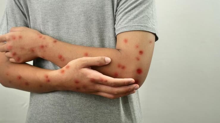 הנגעים של אבעבועות הקוף מופיעים לא פעם באזורים שבהם מתרחשת ההדבקה (צילום: Shutterstock) אבעבועות הקוף