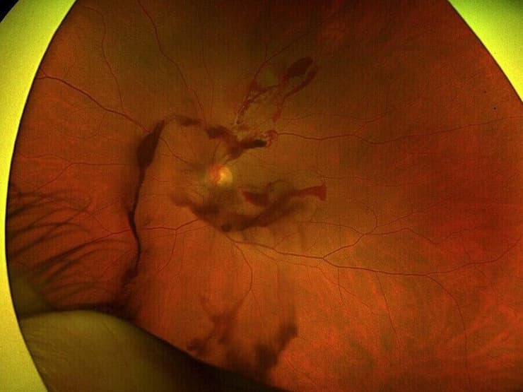 העין של סילביה מרקס נפגעה במהלך דיקור סיני