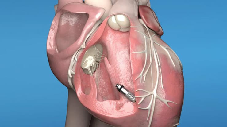 גקפסולת קיצוב, המציעה את קוצב הלב הזעיר בעולם ומפחיתה את הסיכונים המובנים של קוצב הלב המסורתי (צילום: חברת Medtronic) ג