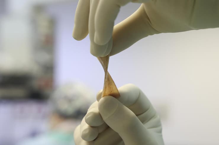עצם גמישה שהוכנה בבנק הרקמות שתשמש כפלטת קיבוע ממתכת כך שהמשתל יהיה עשוי מחומרים ביולוגיים