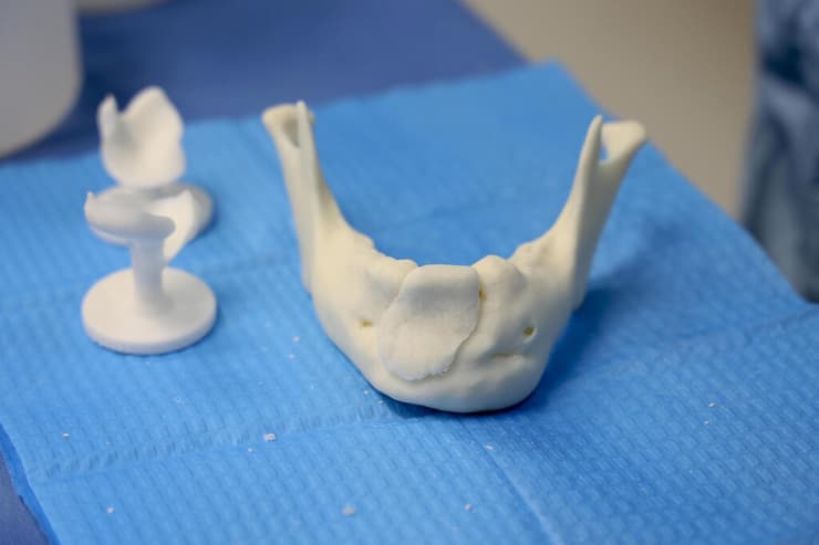 משתל העצם שהוכן בבנק הרקמות 