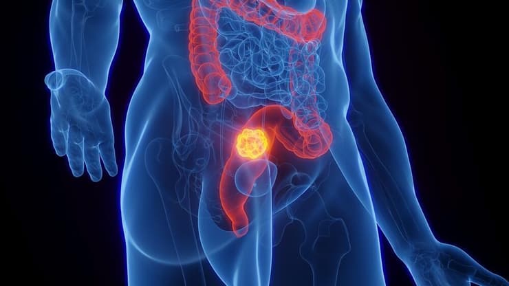 סרטן רקטום חלחולת