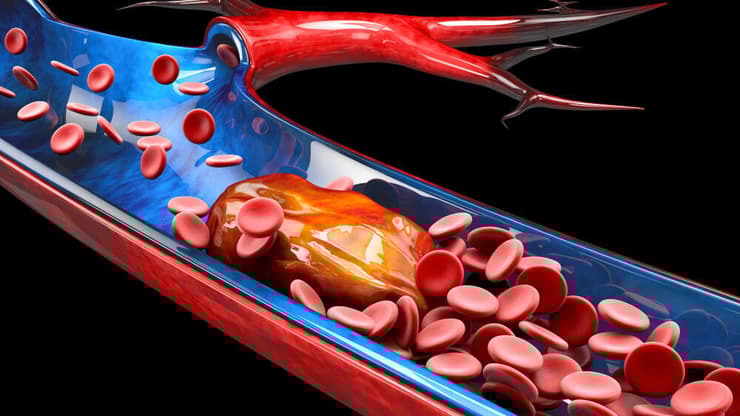 קריש דם בוורידים, שעלול לגרום לתסחיף. אילוסטרציה תלת-ממדית (צילום: Shutterstock) אילוסטרציה תלת-ממדית של קריש דם בוורידים, שעלול לגרום לתסחיף