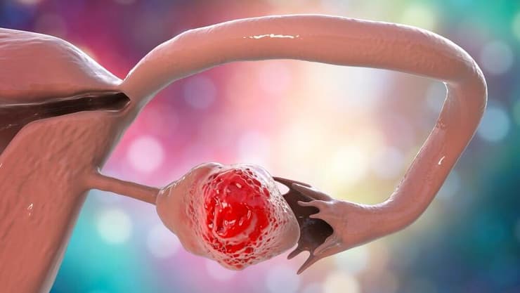 סרטן השחלות