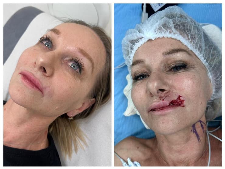 לריסה לפני ואחרי הניתוח