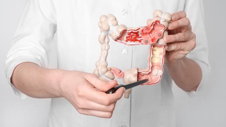 מחלות מעי דלקתיות, מחלת מעי, מעיים