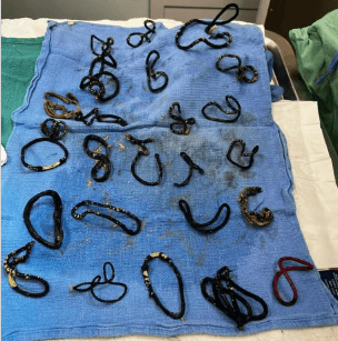 מידנייט והגומיות שהוצאו מגופה