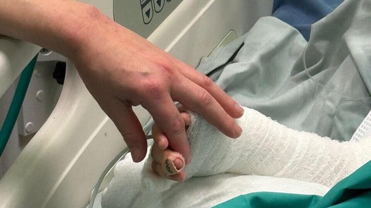 ילד בן ארבע נכווה קשות לאחר שמעד לסיר מרק רותח בבית כנסת וטופל בטיפול נמרץ (צילום: דוברות הדסה) ילד בן ארבע נכווה קשות לאחר שמעד לסיר מרק רותח בבית כנסת ומטופל בטיפול נמרץ בהדסה עין כרם