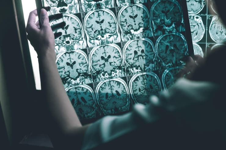 צילום הדמיה MRI של מוח עם אלצהיימר