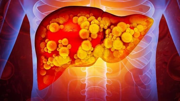 כבד, הצטלקות כבד, פיברוזיס