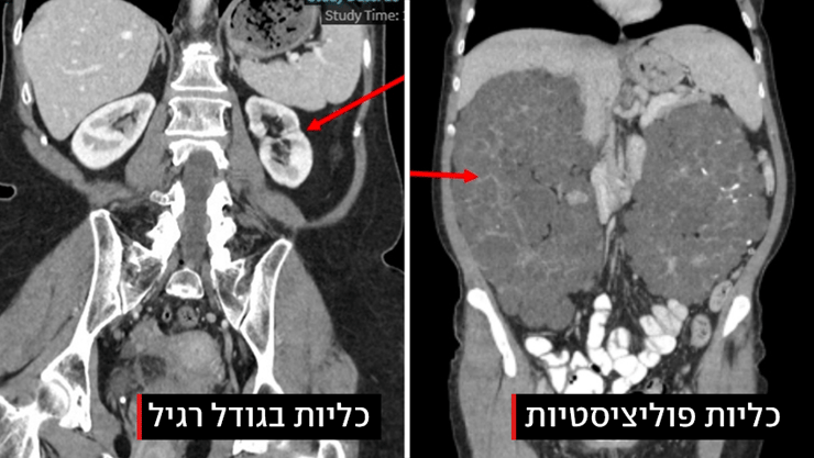 הכליות של אוליאנה שבלה מימין, לעומת כליות בגודל תקין משמאל