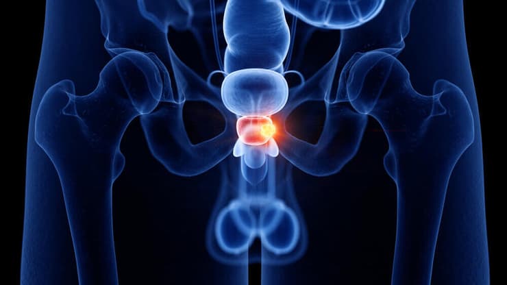 בדיקות MRI וביופסיית פיוז'ן משפרות את היכולת לאבחן ולהעריך את חומרת המחלה (צילום: Shutterstock) ערמונית