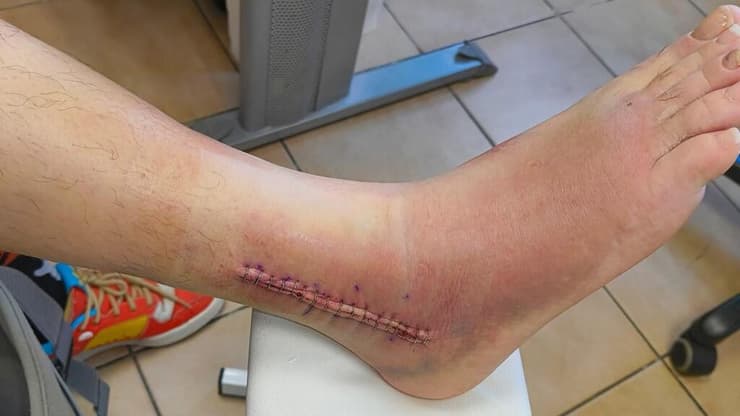 שבר בקרסול צבי דובוש פוסט פייסבוק