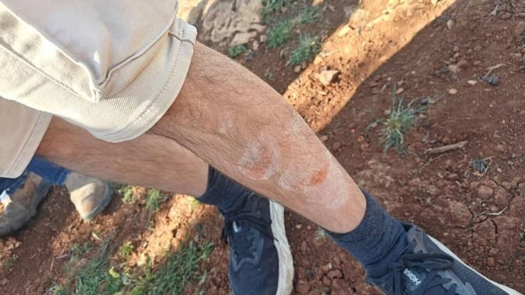 פציעות המטיילים שדיווחו על זריקת אבנים בדיר דבואן