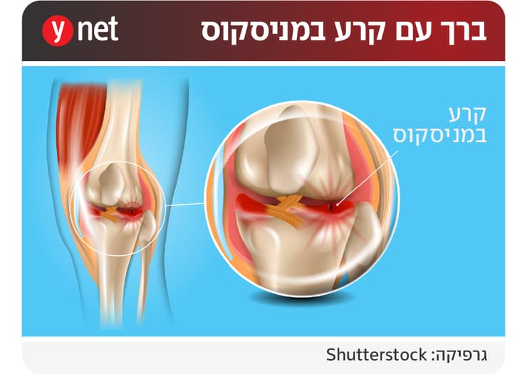 אינפו מניסקוס