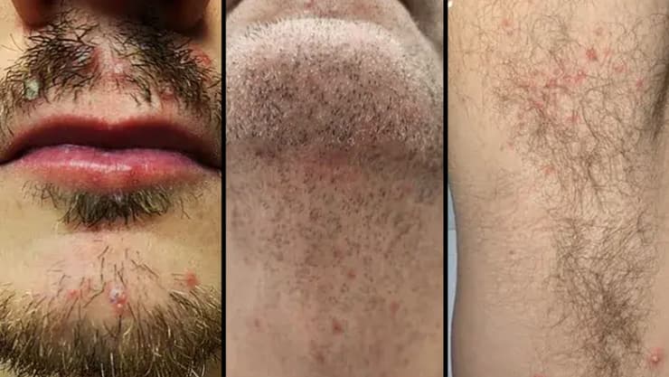 נגעים של דרמטופילוזיס (dermatophilosis), מחלת עור חיידקית של חיות משק שהתגלתה אצל הומוסקסואלים