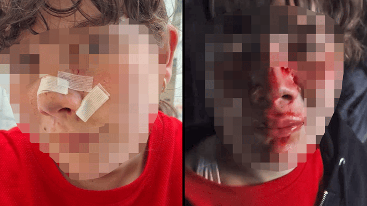 הילדה שהותקפה בידי תן בכינרת (קרדיט: באדיבות המשפחה) הילדה שהותקפה בידי תן בכינרת
